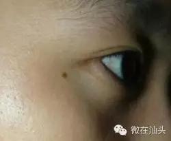一图读懂什么样的痣易癌变,点痣后增生了肉痣会变癌吗