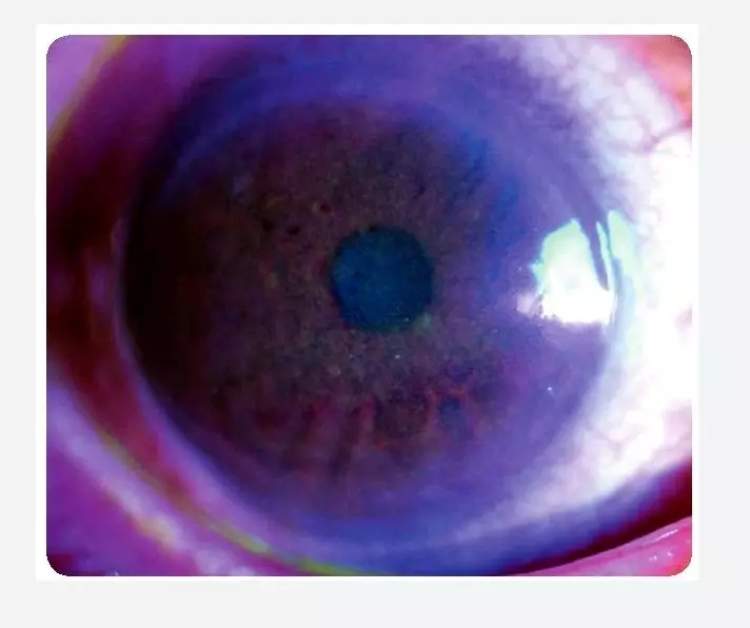 小孩眼红流泪有眼屎用什么滴眼液,孩子眼红有眼屎眼睛痒怎么办