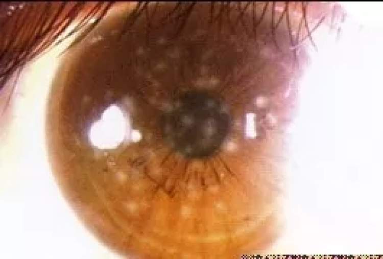 小孩眼红流泪有眼屎用什么滴眼液,孩子眼红有眼屎眼睛痒怎么办