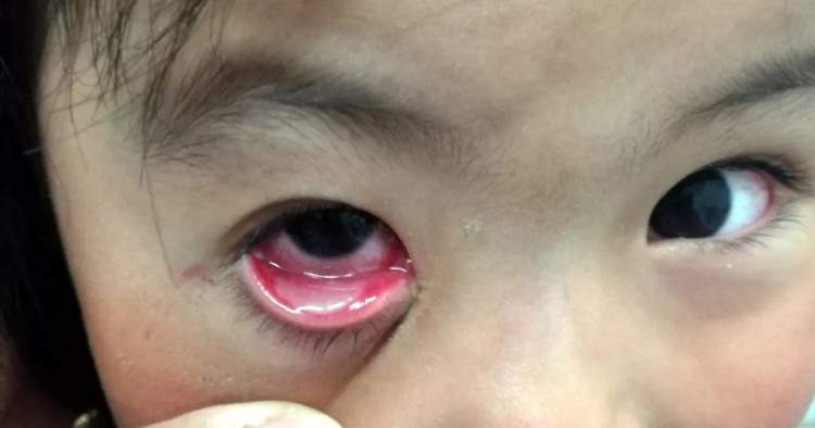 小孩眼红流泪有眼屎用什么滴眼液,孩子眼红有眼屎眼睛痒怎么办