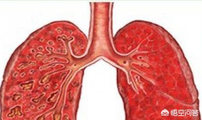 什么是支气管囊状扩张,支气管扩张肺部纹理变粗