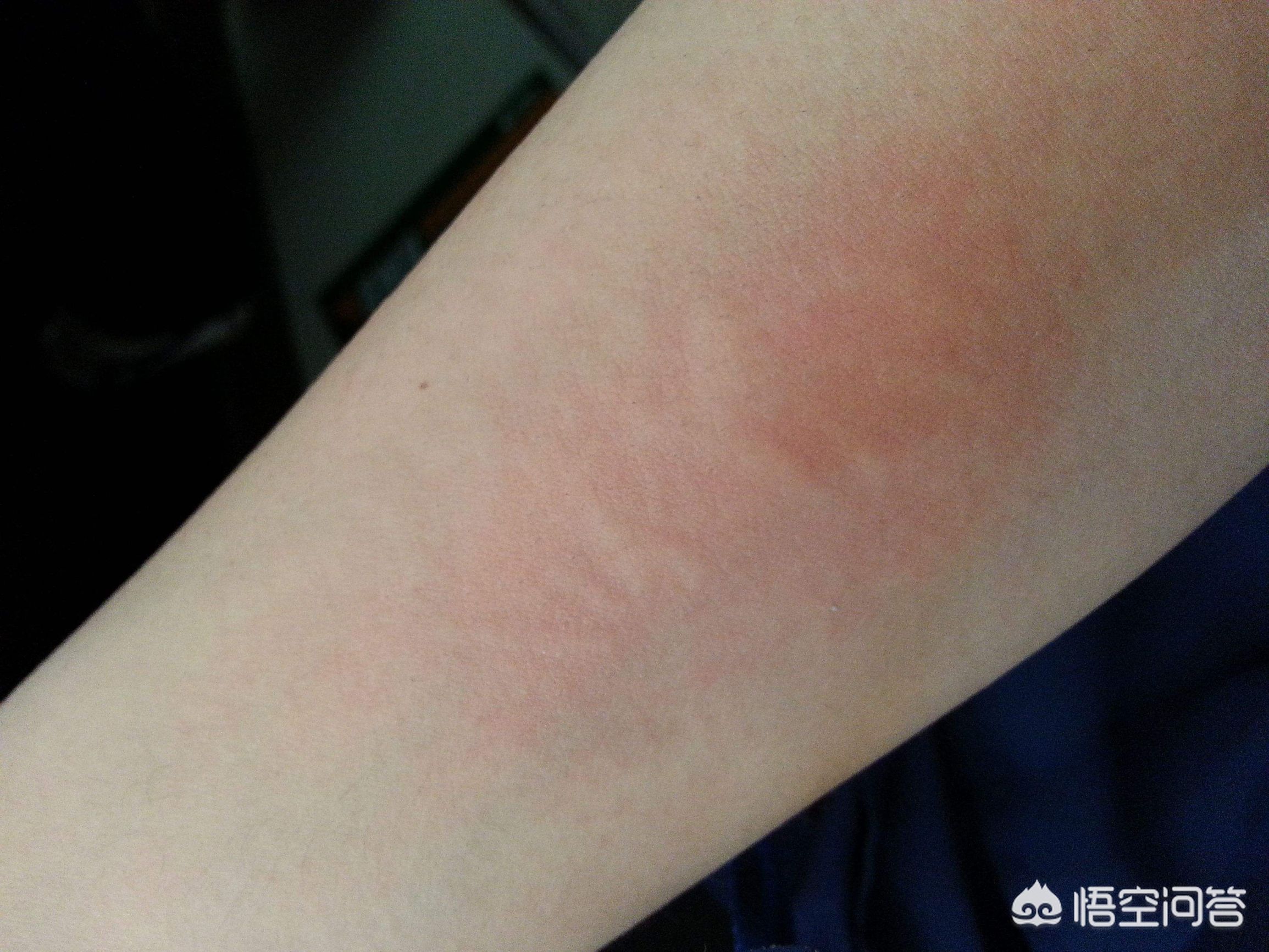 支气管哮喘可以彻底治愈吗,支气管哮喘长期反复发作并发症