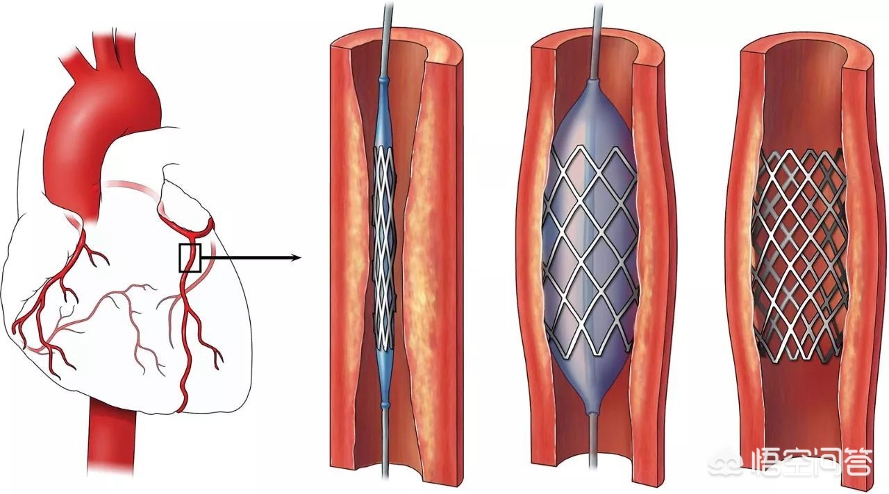 冠心病心衰的中药治疗,2味中药治冠心病视频