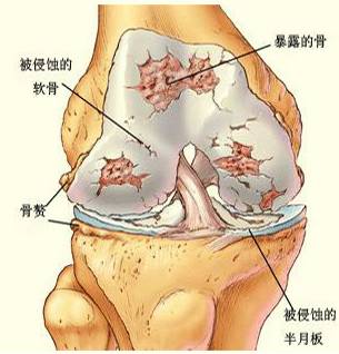 风湿性关节炎夏天如何治疗,怎么去治愈关节炎