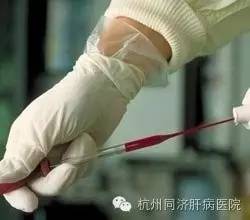 丙肝不治疗会有什么后果,丙肝不治疗有什么后果