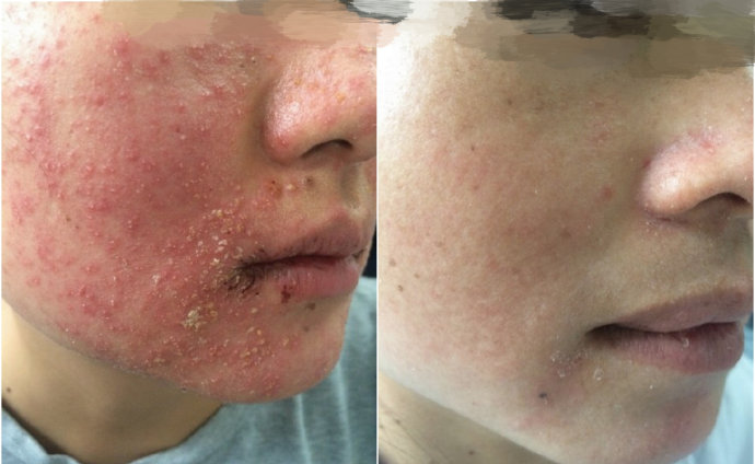 激素依赖性皮炎反复发作怎么办,激素依赖性皮炎该怎样治疗