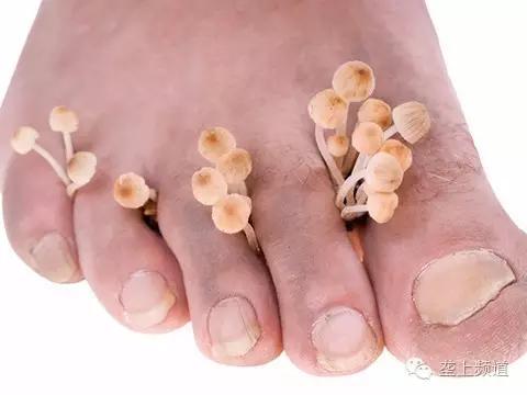 男子去洗浴中心染上疾病,男子去洗脚感染脚气