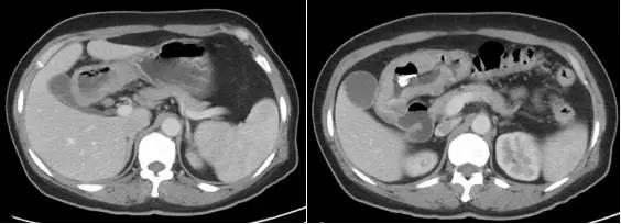 晚期胃癌治疗的思路与误区,晚期胃癌的成功治愈病例