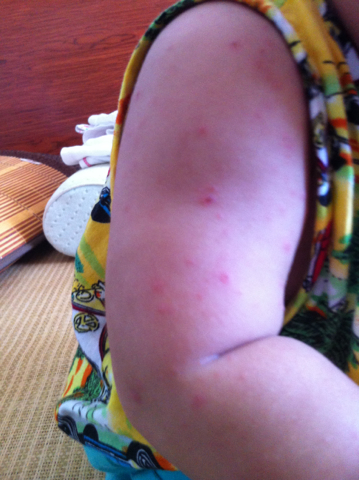 痱子湿疹的症状有哪些,痱子湿疹的治疗方法