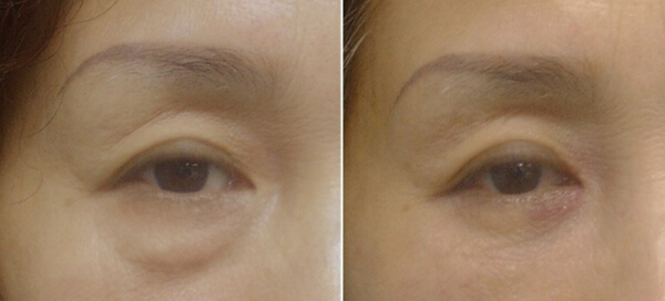 如何区分眼袋泪沟和卧蚕,如何区分眼袋和卧蚕泪沟