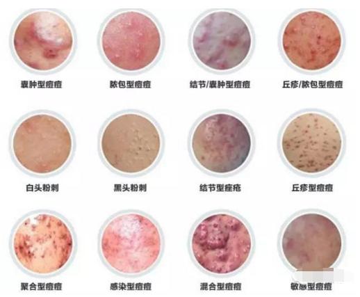 皮肤痘能根治吗,痘疮怎么治好得快