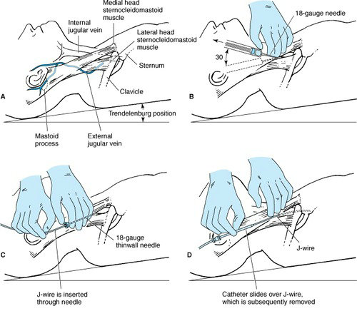 超声引导下改良塞丁格技术解剖图,超声引导下pdca置管