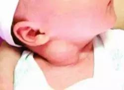 宝宝斜颈过度干预歪得更厉害,痉挛性斜颈的严重危害千万别忽视