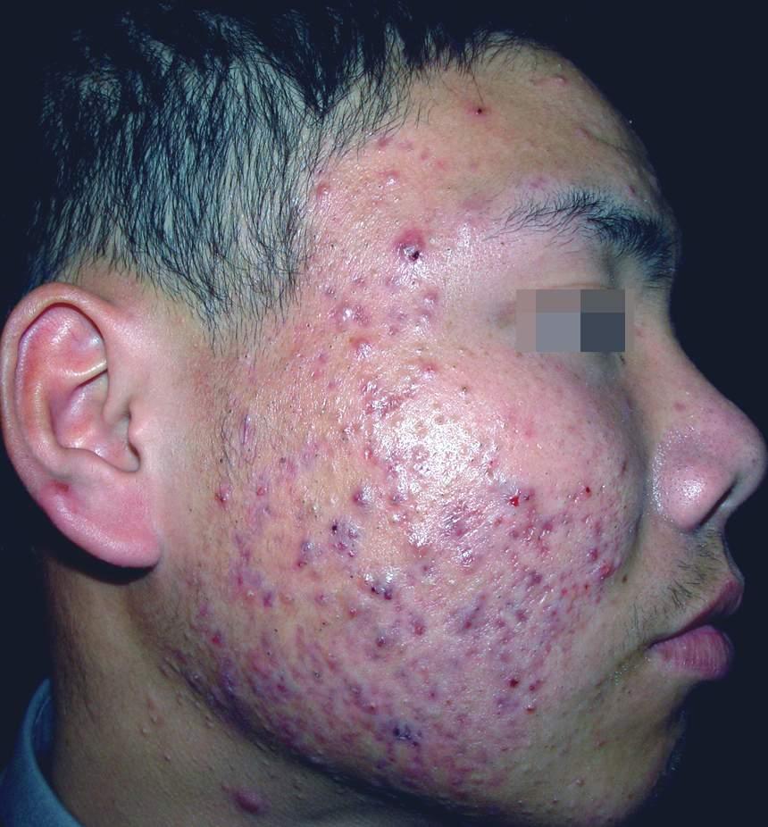 *疮痤**疤痕形成的因素