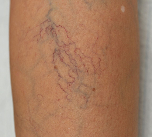 李玉华西医诊所,丹东张爱华治疗静脉曲张