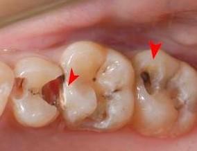 老年人蛀牙很厉害建议拔牙吗,蛀牙快到牙根了需要根管治疗吗