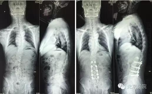 小儿麻痹脊柱侧弯矫正,北京协和医院脊柱侧弯最好专家