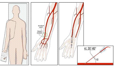 超声引导下改良塞丁格技术解剖图,超声引导下pdca置管