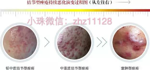 白头粉刺和炎症丘疹的区别,粉刺结节的最佳治疗方法