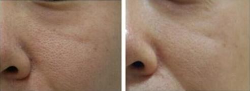 如何改善毛孔粗大痘痘肌,如何改善毛孔粗大的症状