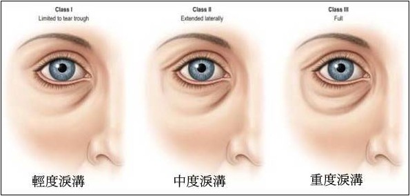 如何区分眼袋泪沟和卧蚕,如何区分眼袋和卧蚕泪沟