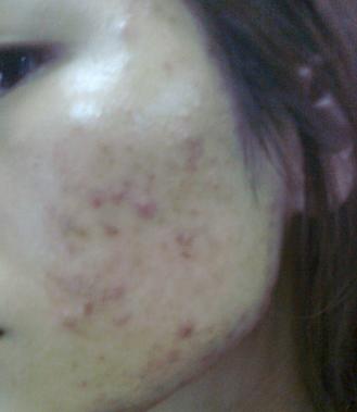 痘痘发炎红肿多久能消退,痘痘发炎红肿怎么办要割掉吗