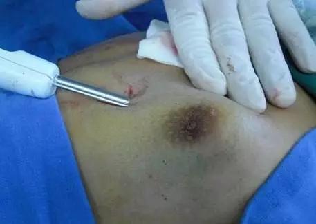 乳腺增生喝什么最快有效,乳腺增生这种问题你怎么对待