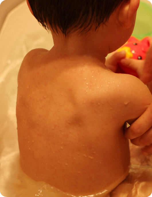 痱子湿疹的症状有哪些,痱子湿疹的治疗方法