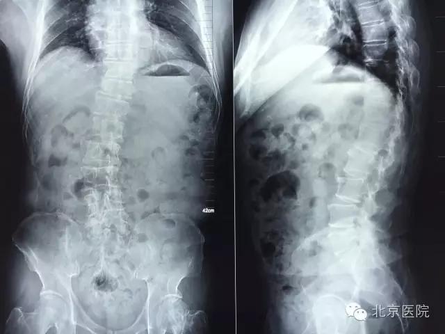 小儿麻痹脊柱侧弯矫正,北京协和医院脊柱侧弯最好专家