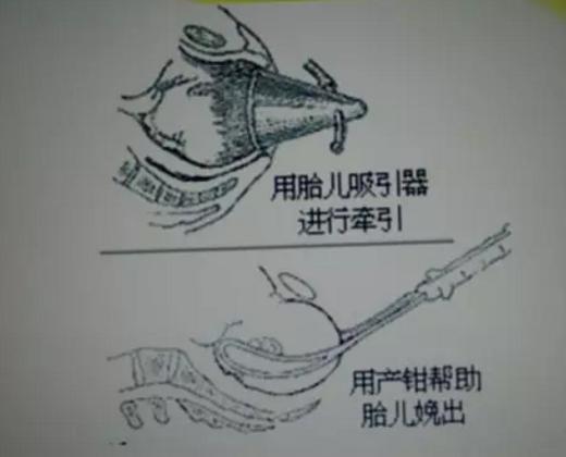 如何配合医生快速自然分娩（下）