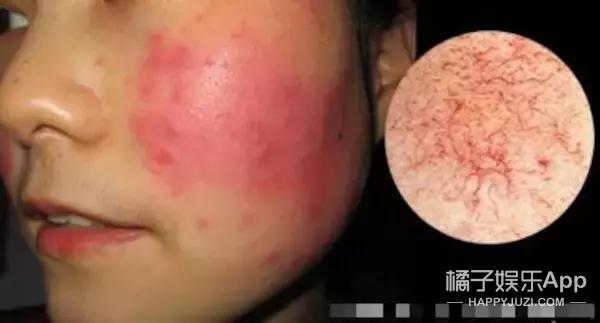 敏感肌脸发烫怎么快速解决,敏感肌发红发烫是有炎症吗