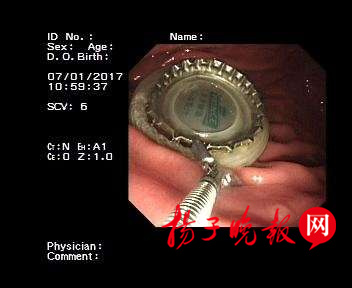 男子喝啤酒太猛吞下瓶盖医生借助“套套”将盖子取出