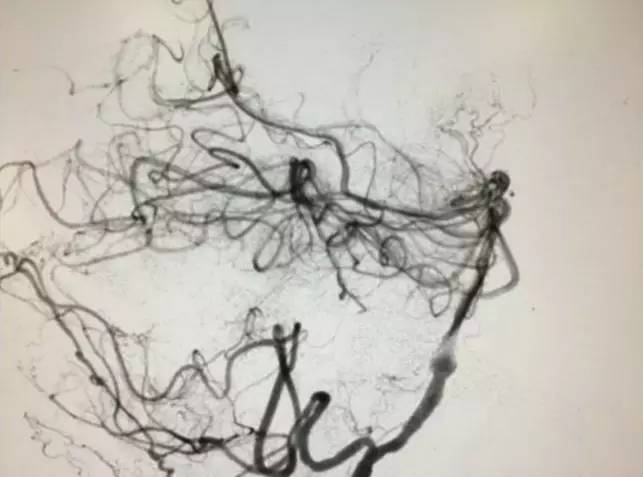 市人民医院取栓手术的全过程,病例分享视频素材