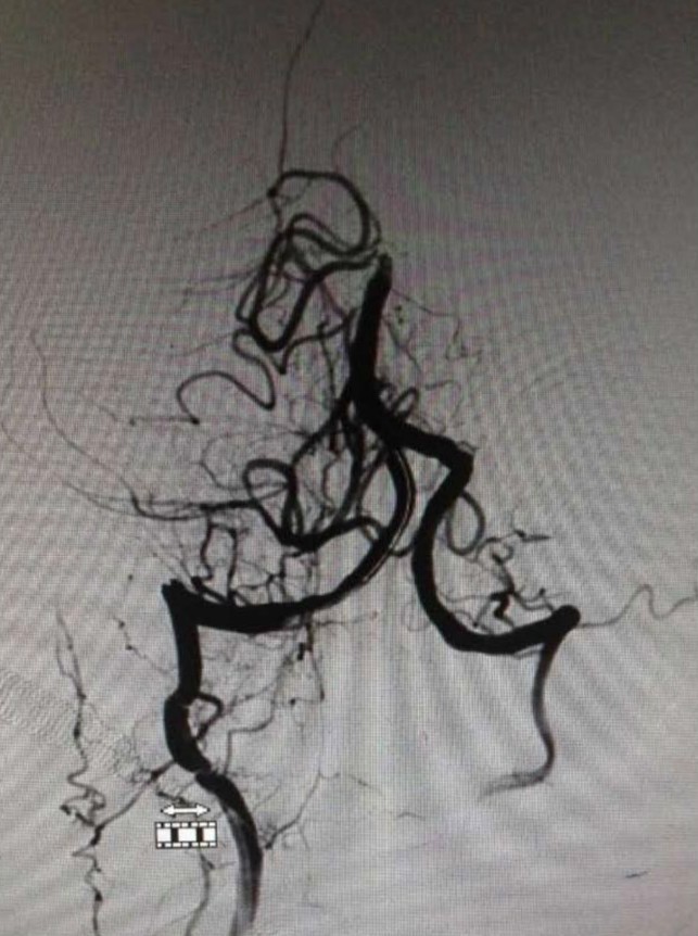 市人民医院取栓手术的全过程,病例分享视频素材