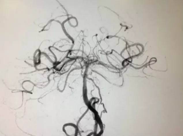 市人民医院取栓手术的全过程,病例分享视频素材