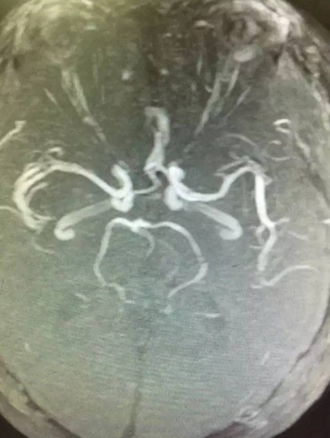 市人民医院取栓手术的全过程,病例分享视频素材