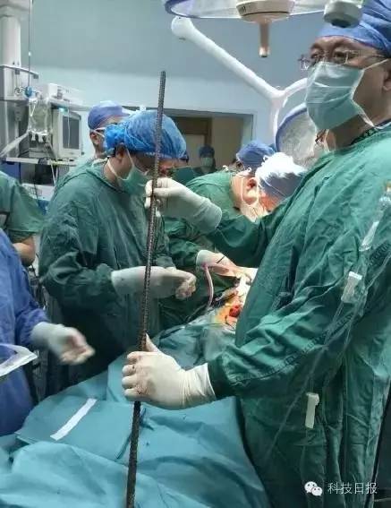 50厘米钢筋贯穿腹腔,1米长钢筋贯穿腹部