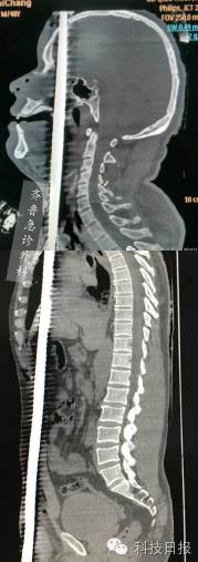 50厘米钢筋贯穿腹腔,1米长钢筋贯穿腹部
