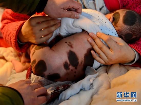 孩子患上罕见兽皮痣视频,新生儿巨型黑色素痣