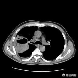 肺上有个洞吐出来的痰又臭又黑,轻微肺堵塞能咳出痰很浓的痰