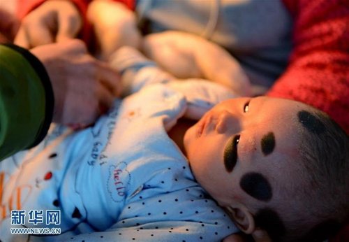 女婴患巨型兽皮痣,罕见病兽皮痣