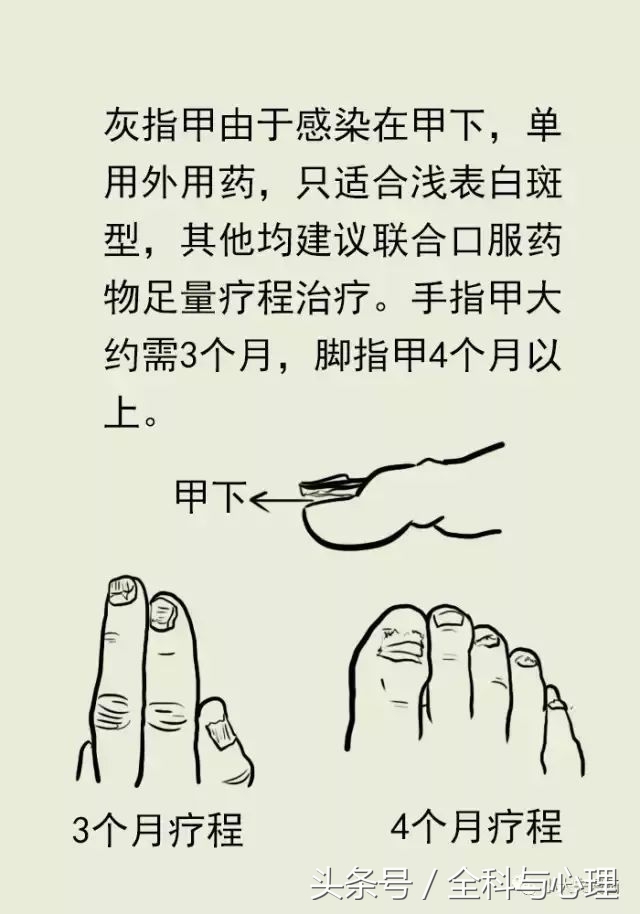 脚气冬天治好还是夏天治疗好,夏天来了脚气提前预防