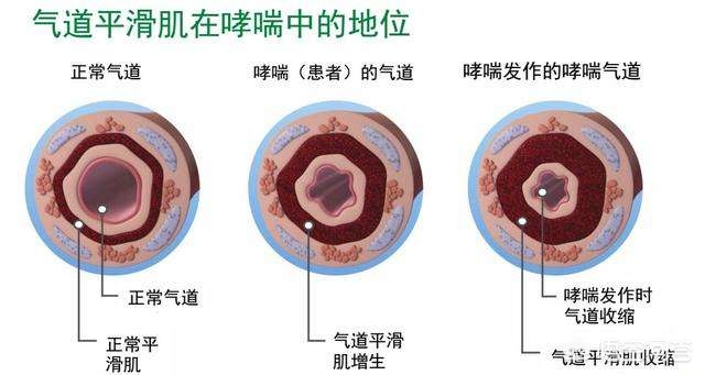 支气管哮喘能长期服用阿斯美吗,支气管哮喘长期抗炎首选药物是