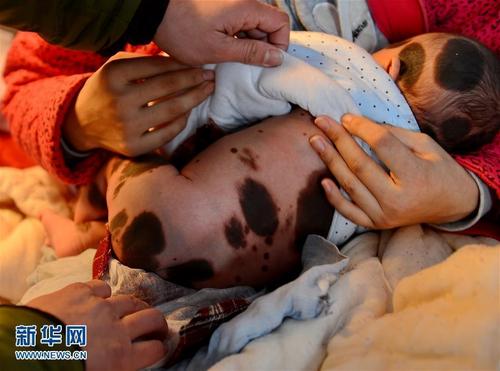 女婴患巨型兽皮痣,罕见病兽皮痣