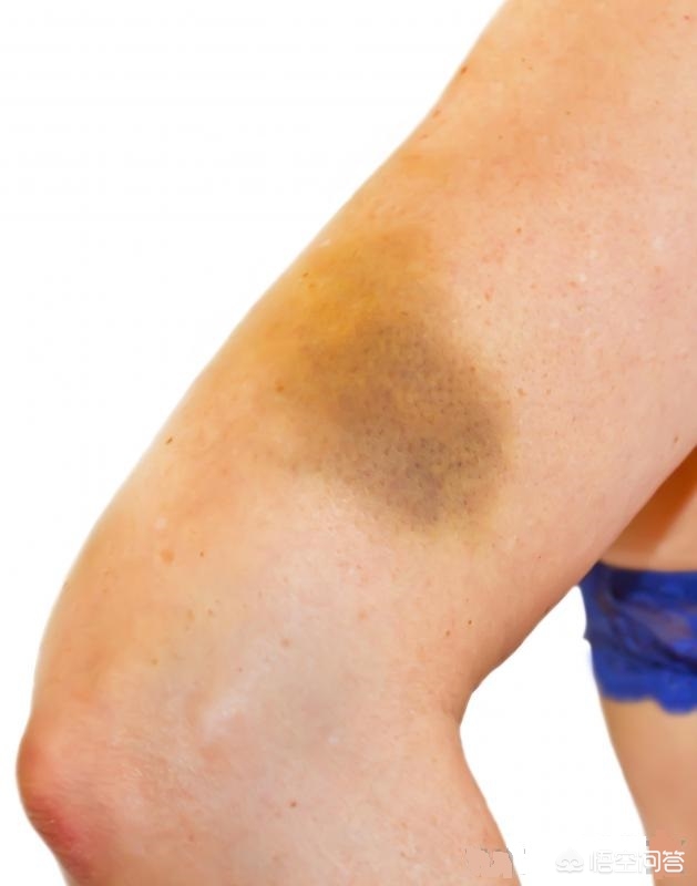 月经期为什么会有淤青,月经期褐红分泌物怎么回事