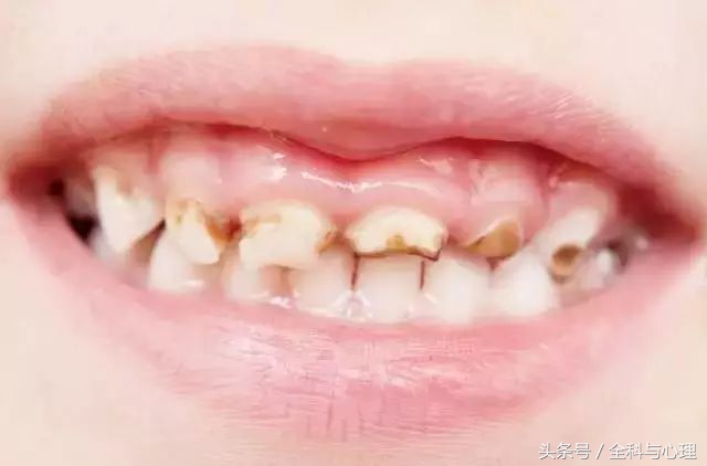 乳牙蛀了不疼要补牙吗,乳牙蛀了要不要治疗