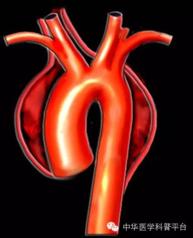 主动脉夹层疼痛位置,主动脉夹层什么症状