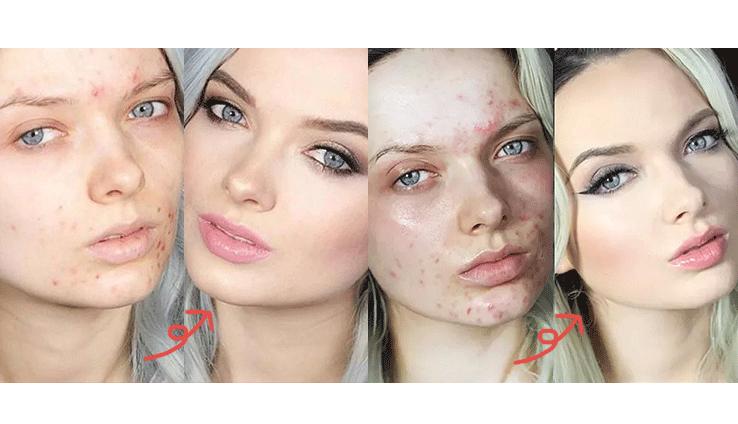 祛痘的尽头,祛痘的尽头是什么