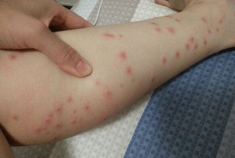 你被蚊子咬了吗是什么梗,四川墨蚊咬了以后怎么治疗