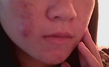 终于摆脱爱情的困扰,彻底告别痘痘的烦恼